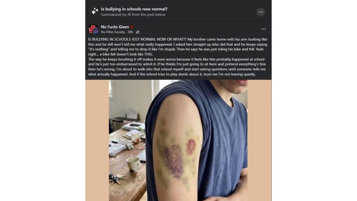 Memphis, TN – Viral Facebook Post Raises Concerns After Teen Comes Home With Severe Arm Bruises, Family Suspects School Bullying